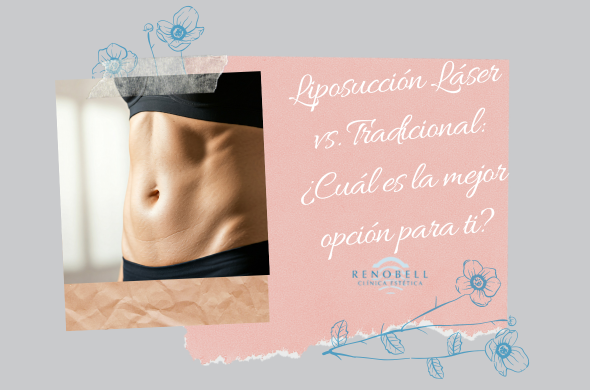 liposuccion-laser